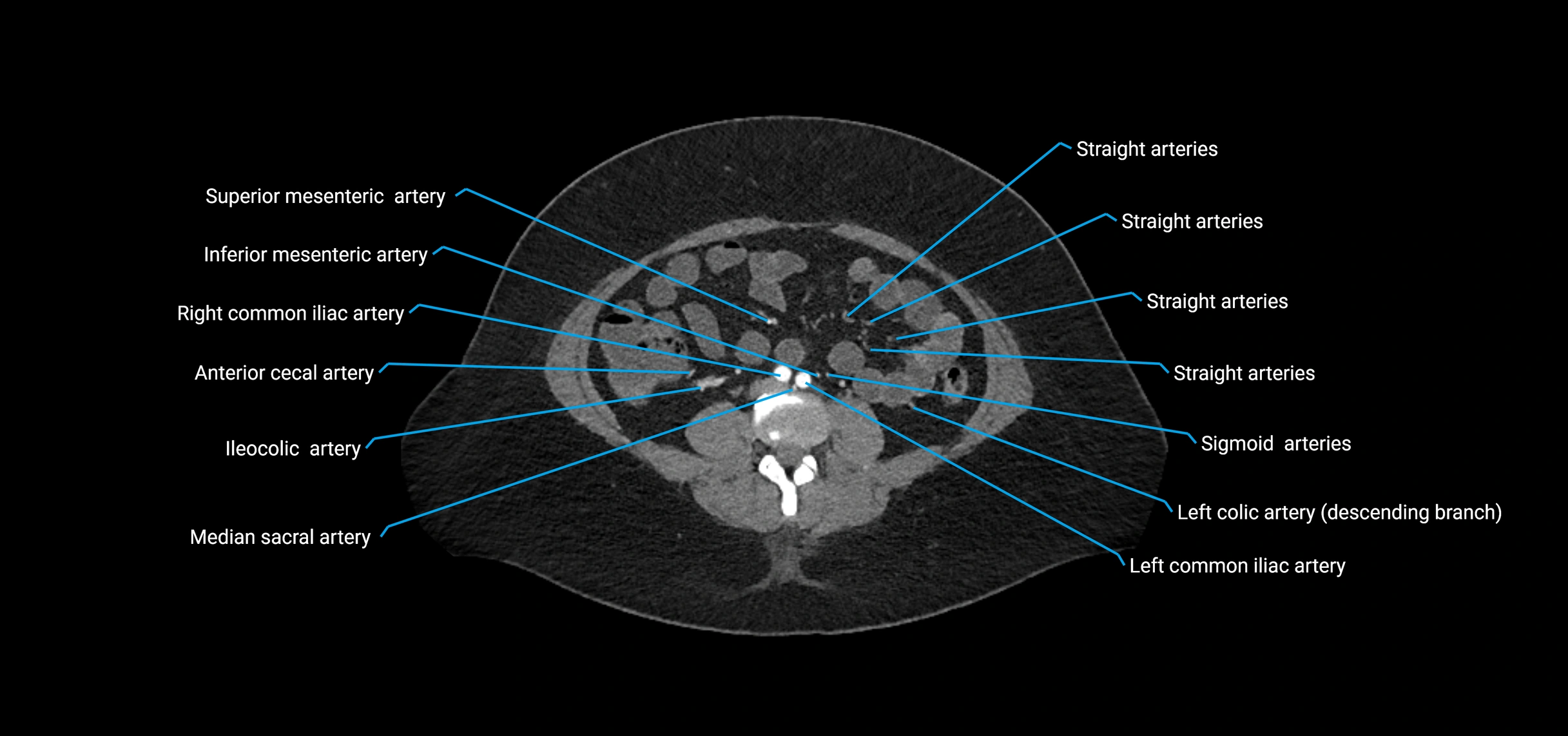 CTA abdomen axial cross sectional anatomy labelled image_130 (2).webp